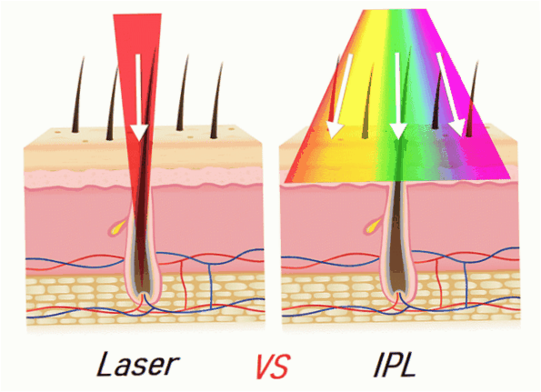 Laser- und Photoepilation